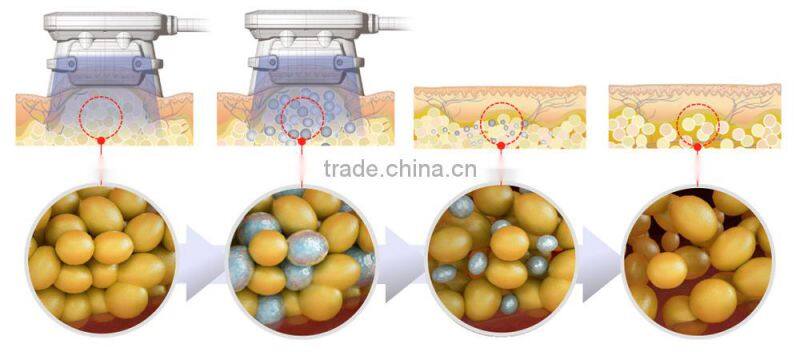 Best choice home cryolipolysis machine slimming system cryolipolysis machine in usa