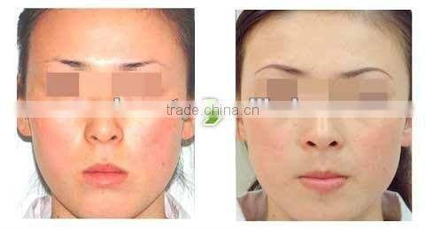 Mini Professional removal hair for leg hair body hair E-light (IPL+RF)