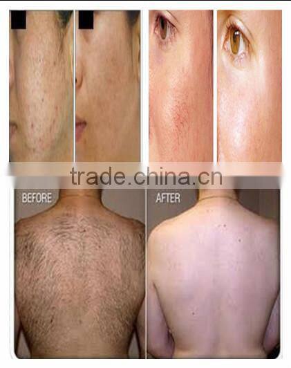 ipl skin rejuvenation machine home rf e-light machine skin tightening ipl