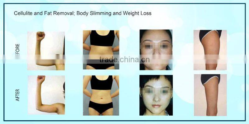 2016 Anybeauty SL-3 lipolaser slimming machine / machine i lipo laser