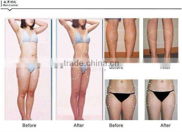 cavitation rf cryolipolysis equipment