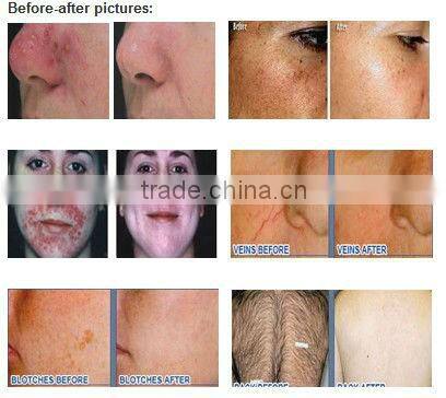 hair removal ipl photofacial machine/ipl xenon flash lamp