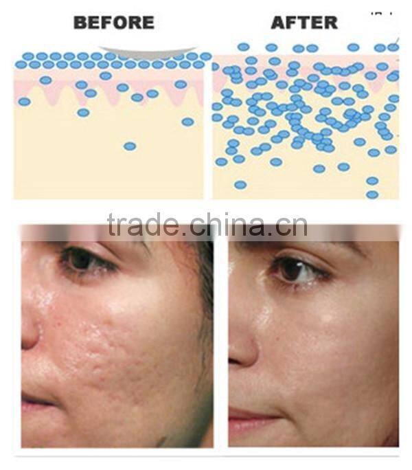 HOT!! derma roller 540 needles face derma roller with bottom price