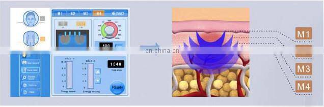Fractional RF & Thermal RF 2 in 1 device face/body tightening /acne scars treatment GSD Dermatrix Pro