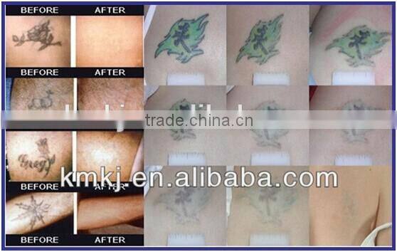 Best price 2015 hair removal machine with CE certificate