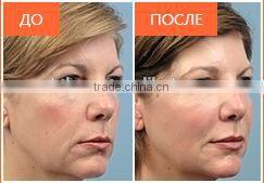 MBT LASER shr ipl Professional Multifunction digital permanent hair removal skin rejuvenation opt machine