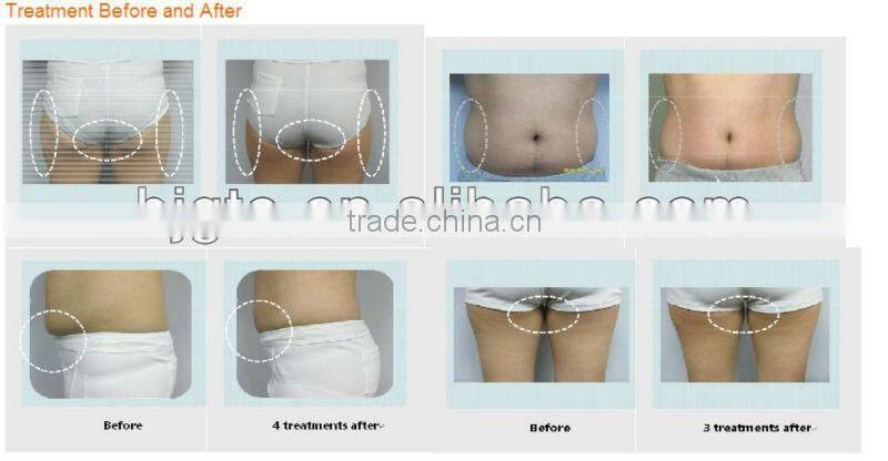 2015 new cavitation RF slimming machine weight loss machine