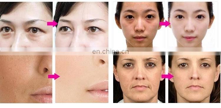 Intelligent Ice Blue Advanced Skin Analyzer RF Head With Mobile App Connection Facial Machine for skin management