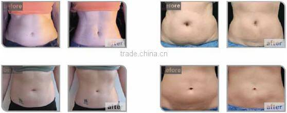 Focused ultrasound slimming 4d best ultrasound machine