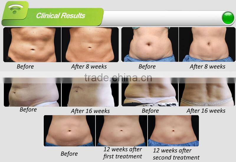 Cryotherapy cryolipolysis slimming equipment, 3 interchangeable cryo handles