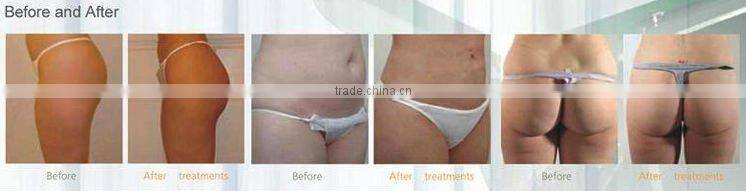 Tripolar RF Face Lifting RF Wrinkle removal