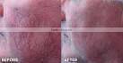 epilator pulsed light ipl skin rejuvenation machine A003