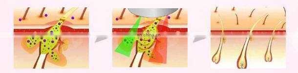 DEESS 3 in 1 with effect replaceable lamps device ipl hair removal beauty product