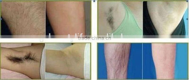 New 808 diode laser/808nm hair removal