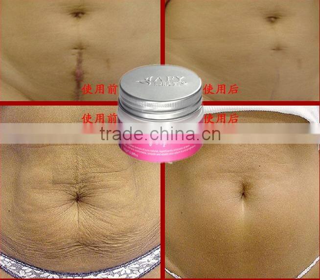 Stretch marks cream,postpartum obesity , pregnancy repairing cream, slack line,dsmv a potent repair scar products