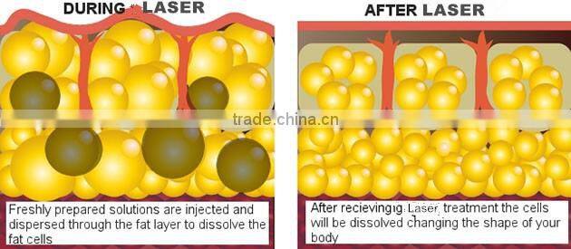 Cryolipolysis Cavitation RF Skin tightening Face Lifting Machine