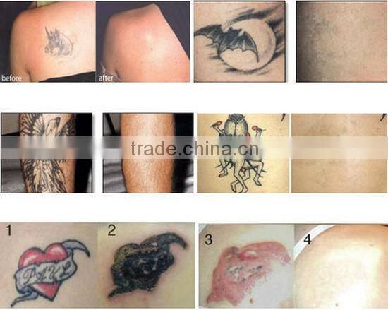 Promotional lowest price!!! New q-switched tattoo removal/permanent make up tattoo machine
