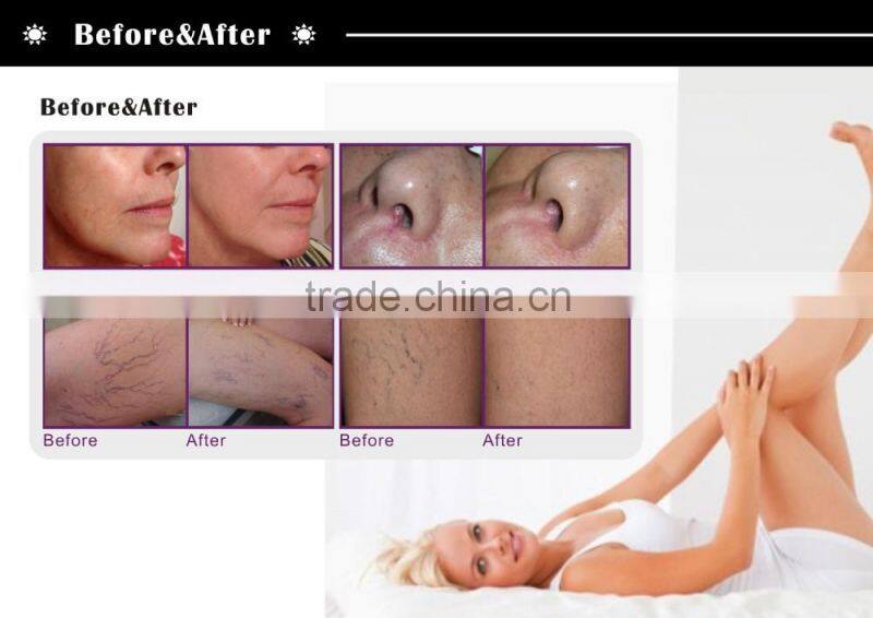 mini Blood Vessels Removal Spider Vein Removal Vascular Removal machine