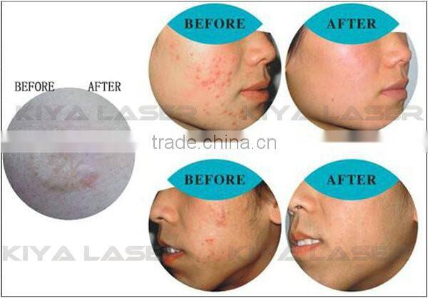Kiyalaser manufacturer! acne treatment products