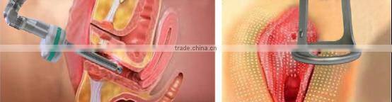 laser scar removal machine / laser acne removal machine / co2 laser for vaginal tightening