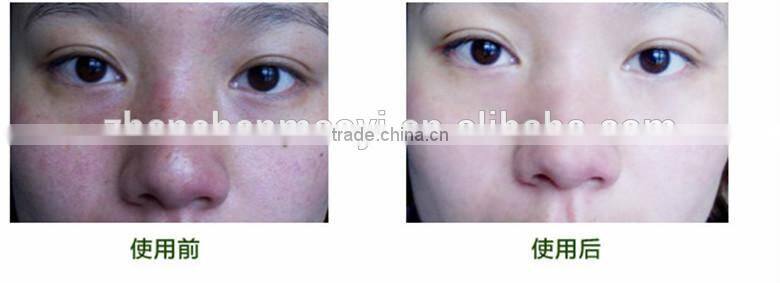 AFY new generation natural aloe vera extract aloe vera juice remove Acne Oil for skin lightening