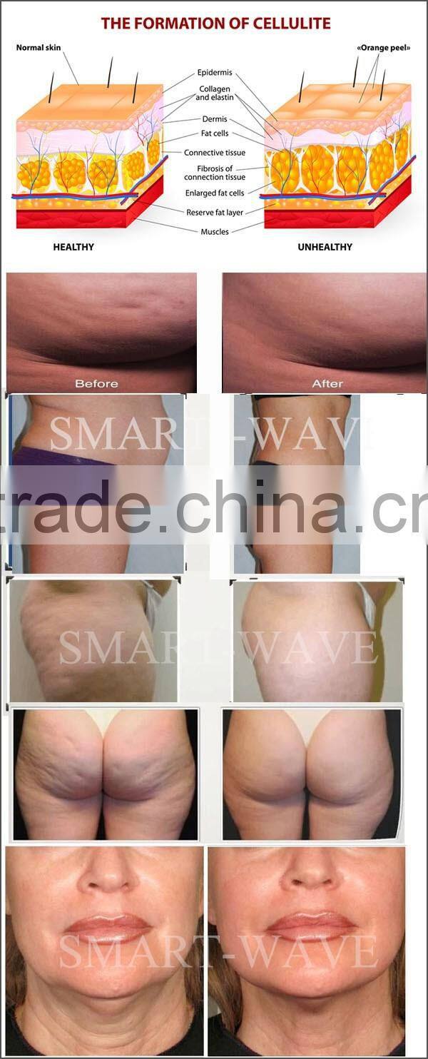 shockwaves machine for Cellulite removal/Loose skin get tightened/Connective tissue /Body Reshaping and slimming