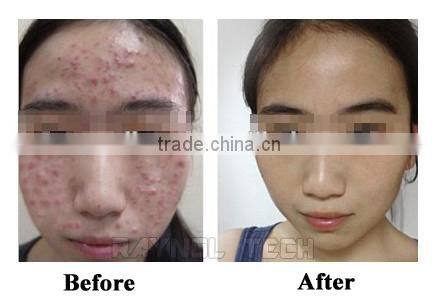 30W RF Tube Co2 Fractional Laser for Acne Skin Care