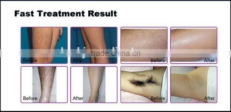 Updated laser diode 808nm diode laser machine with Itlay pump