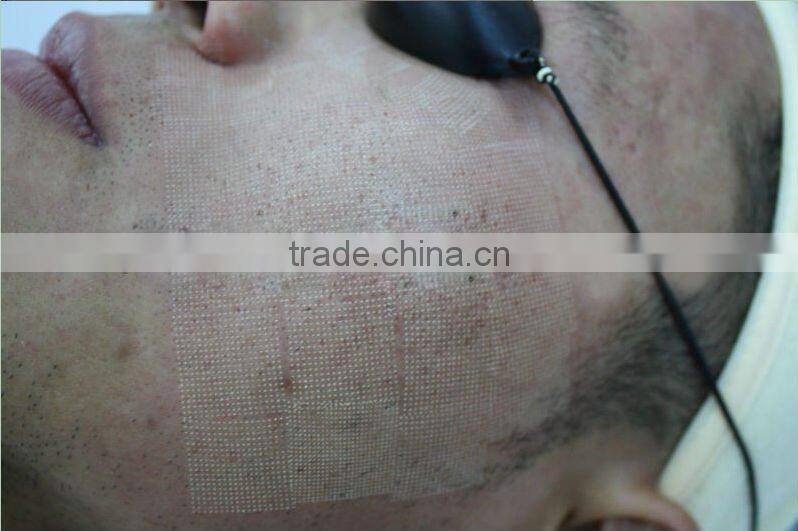 professional co2 laser RF tube price for scar removal and skin resurfacing laser