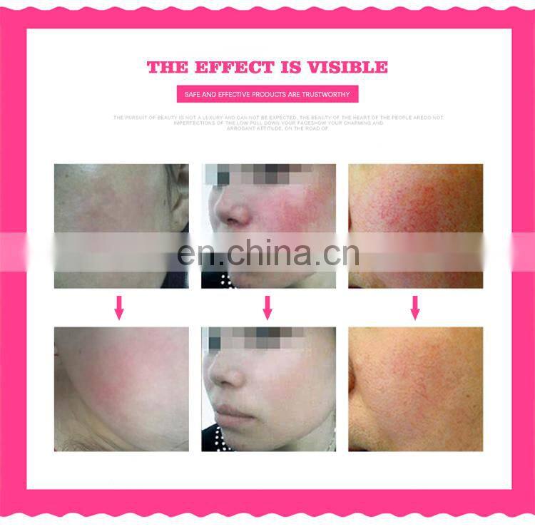 portable 980 diode laser vascular laser beauty equipment