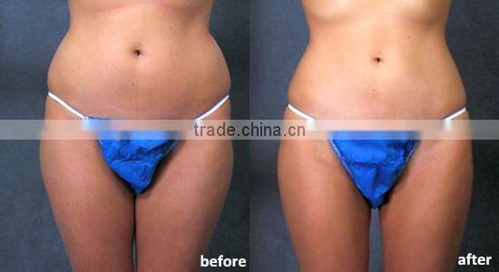 portable ultrasound fat reduction portable ultrasound machine