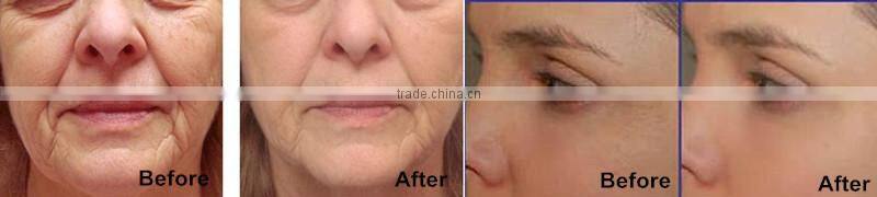 Apolo bipolar rf skin rejuvenation beauty machine