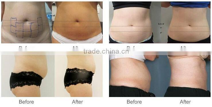 Lose belly fat quickly/ New tech of 13mm depth HIFU reduce fat at once