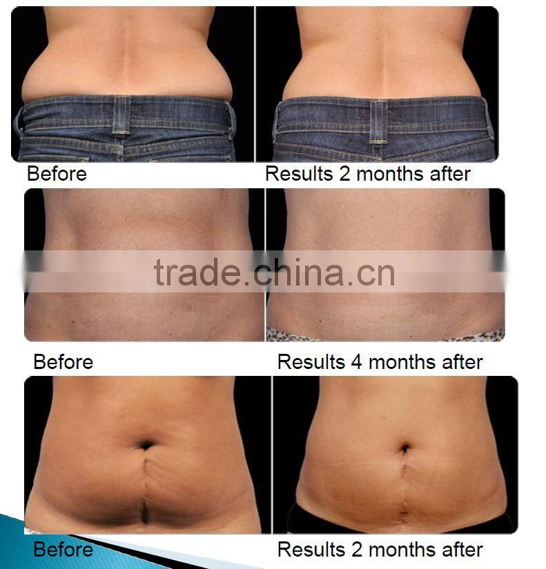 The advanced vacuum shape for body slimming/vela shape massage