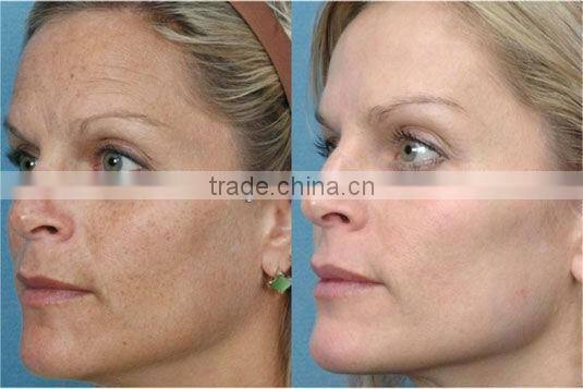 Health Care Beauty Equipment ipl rf filter 430 nd yag laser hair removal machin