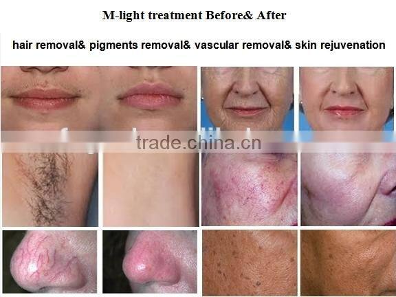 super hair removal machine with IPL SHR Elight OPT from beijing fogool