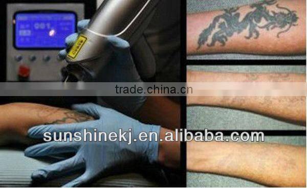 TUV/CE approved nd yag laser dark skin tattoo removal with 1064&532 nm