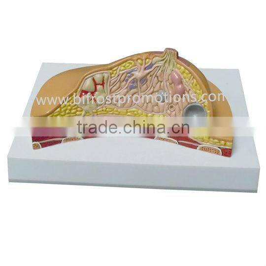 Teaching Breast Model, Mastitis Anatomical Model