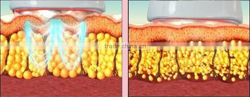 Cavitation Fat Burning Cellulite Reduction