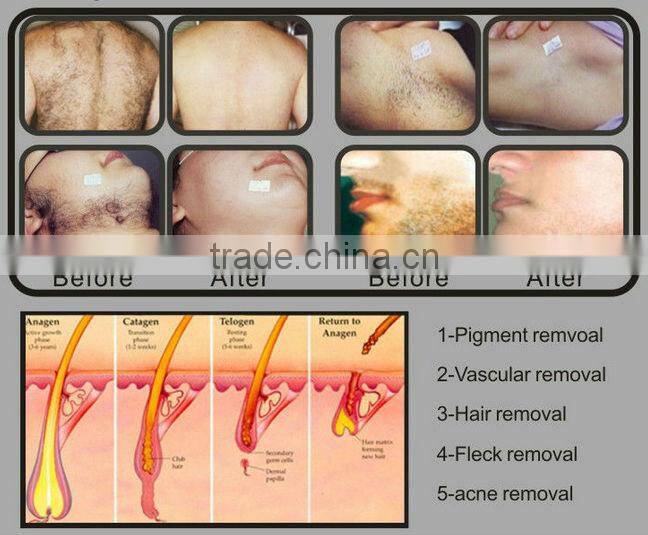 Pain-free Depilation Device hair removal SHR IPL