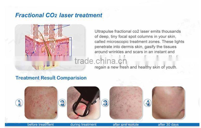 JMSHR Salon/Hospital Use 30W Korea Import Arm CO2 Fractional Laser RF Tube For Eyebrow Lid Removal