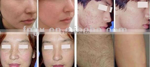 Super quality professional freezing vacuum beauty equipment