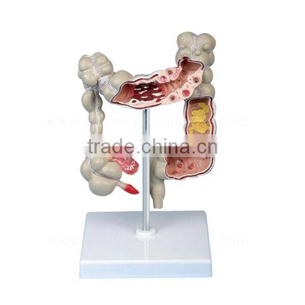 Pathology Colon Model Organs Human Body Anatomy