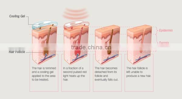 spa equipment ipl photoderm skin rejuvenation equipment ipl manufacturer