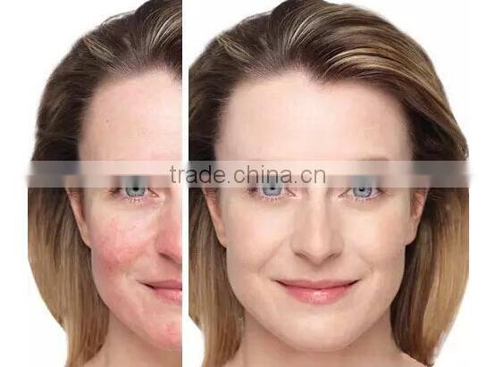 professional diode laser blood vessels removal spider vein / vascular removal equipment