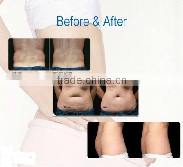 latest technology cryo non invasive fat removal /non invasive fat reduction for man