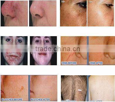 2014 newest design multi-functional skin rejuvenation best ipl korea