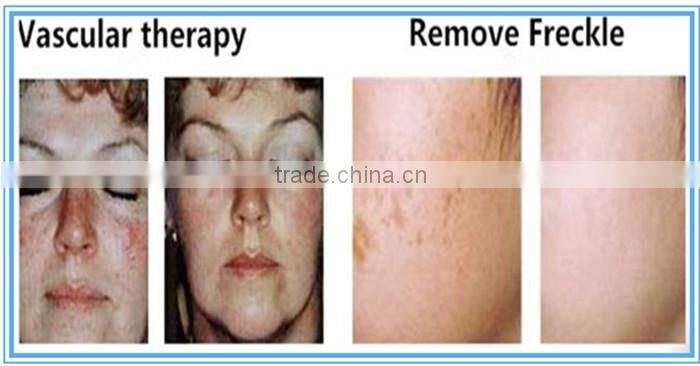 shr ipl Hair Removal / shr hair removal machine / shr laser