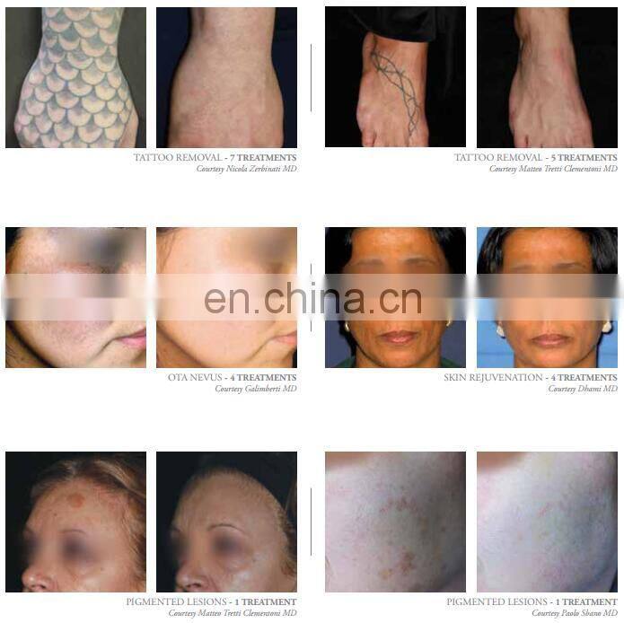 Portable 2 in 1 Professional Beauty Equipment 755 808 1064 Diode Hair ND Yag Tattoo Removal Laser Machine