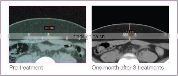 Ultrashape HIFU Body Slimming Machine ultrasonic lipolysis slimming machine